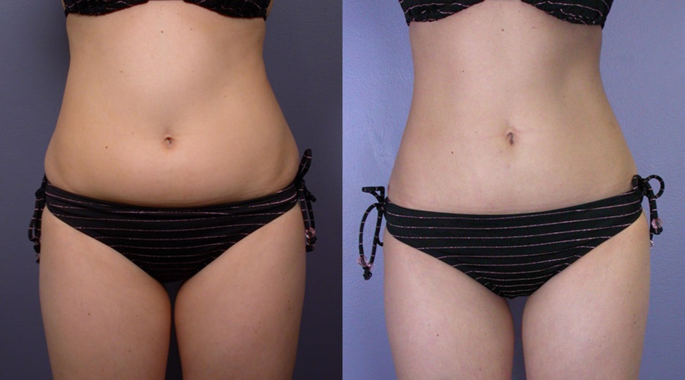 Liposuction Surgery