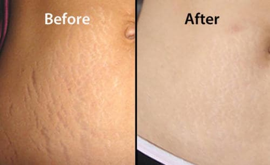 Stretch Marks Reduction