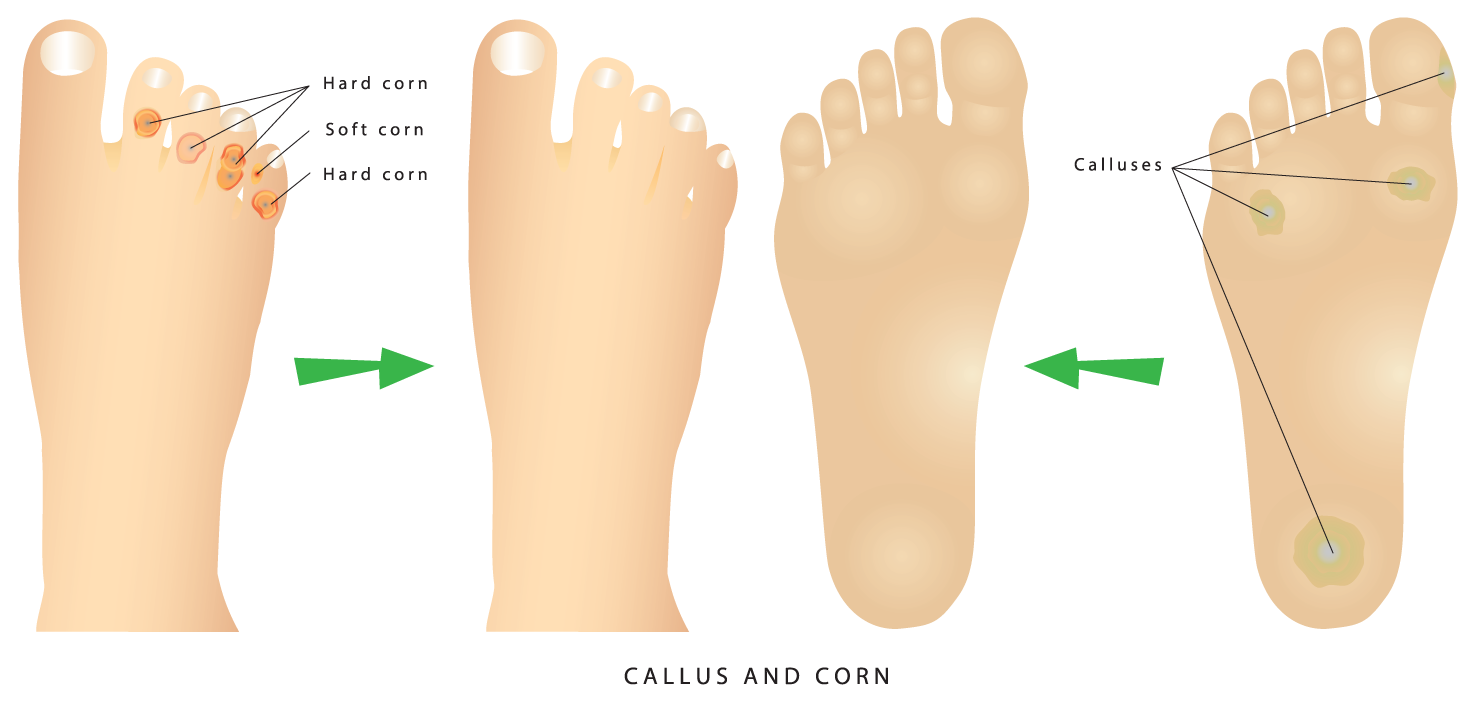 Corn And Calluses Treatment