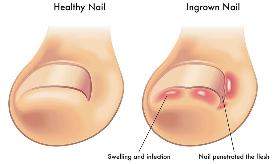 Ingrown ToeNails Treatment