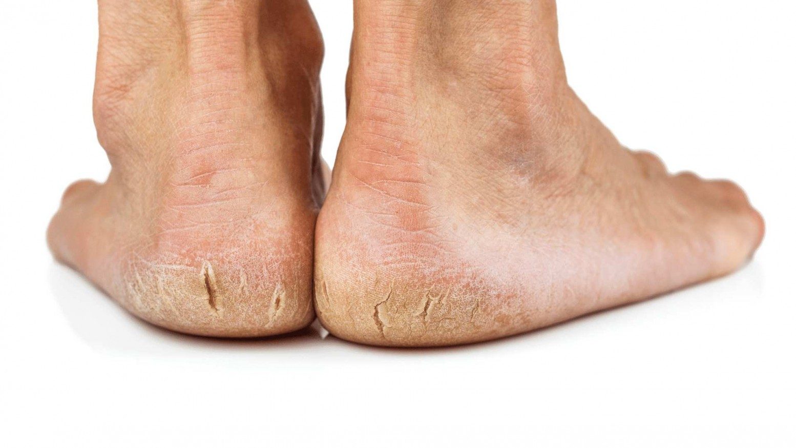 Foot Care And Heel Fissures Treatment