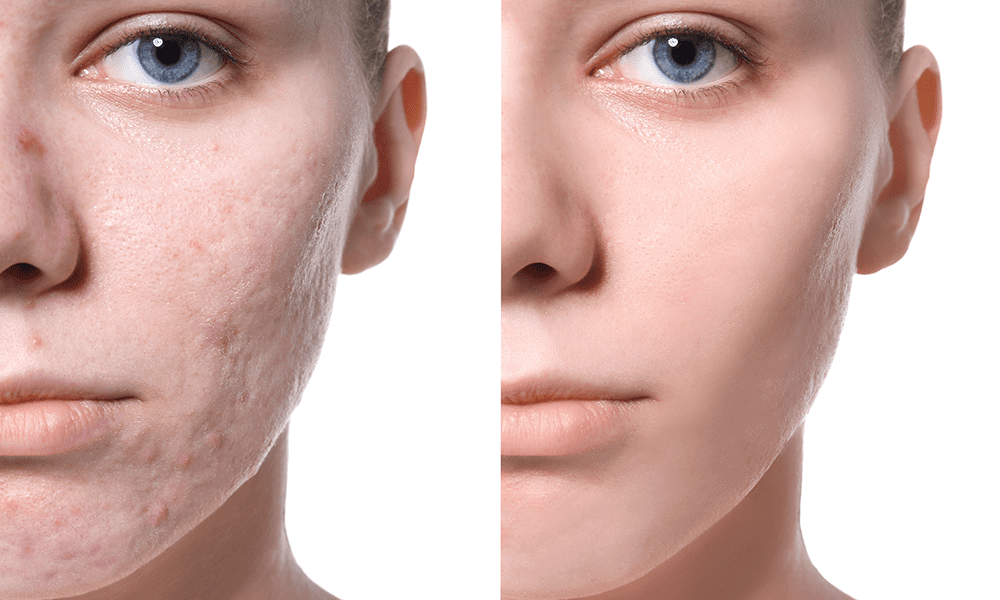 Removal Of Acne Scars