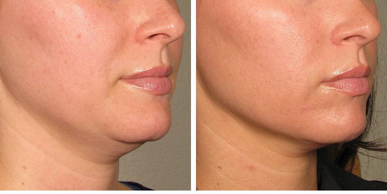 Skin Tightening