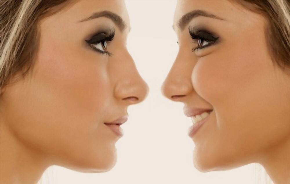 Non-Surgical Nose Job