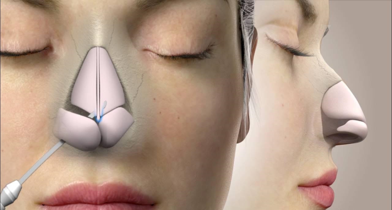 Rhinoplasty Surgery