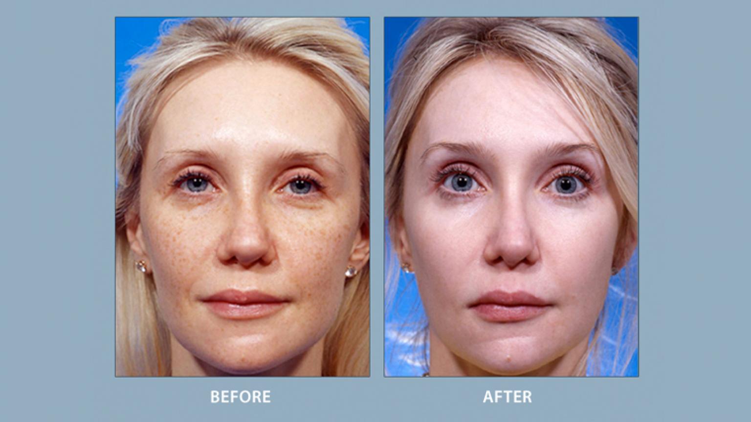 Facial Implants Treatment