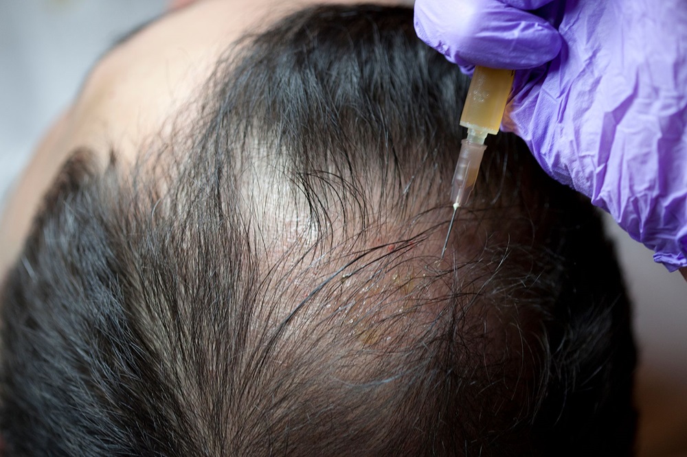 PRP Treatment For Hair