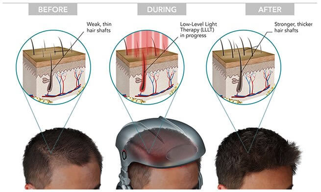 Low Level Laser Therapy