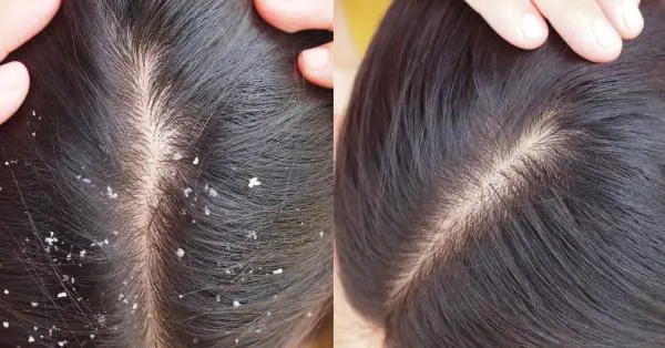 Dandruff Control Treatment